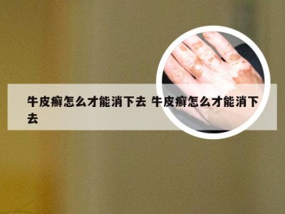 牛皮癣怎么才能消下去 牛皮癣怎么才能消下去