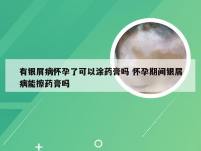 有银屑病怀孕了可以涂药膏吗 怀孕期间银屑病能擦药膏吗