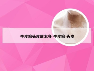 牛皮癣头皮屑太多 牛皮癣 头皮