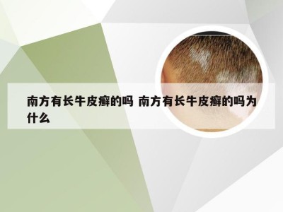 南方有长牛皮癣的吗 南方有长牛皮癣的吗为什么