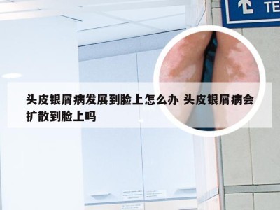 头皮银屑病发展到脸上怎么办 头皮银屑病会扩散到脸上吗