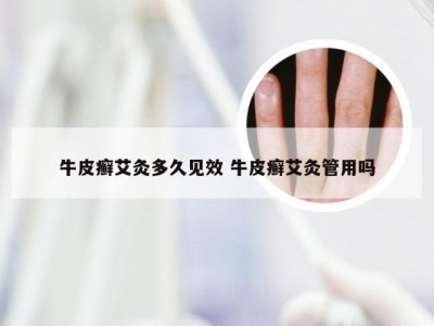 牛皮癣艾灸多久见效 牛皮癣艾灸管用吗