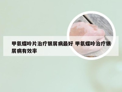甲氨蝶呤片治疗银屑病最好 甲氨蝶呤治疗银屑病有效率