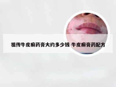 祖传牛皮癣药膏大约多少钱 牛皮癣膏药配方