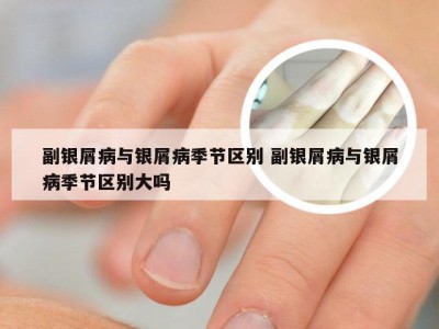 副银屑病与银屑病季节区别 副银屑病与银屑病季节区别大吗
