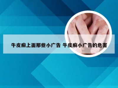 牛皮癣上面那些小广告 牛皮癣小广告的危害