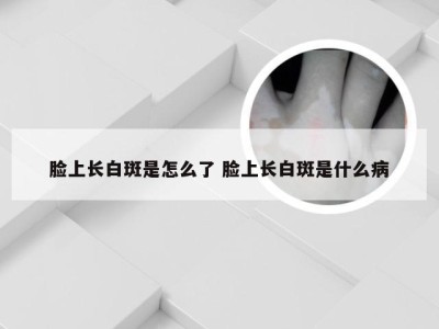 脸上长白斑是怎么了 脸上长白斑是什么病