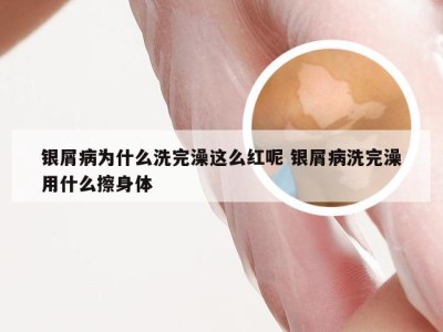 银屑病为什么洗完澡这么红呢 银屑病洗完澡用什么擦身体