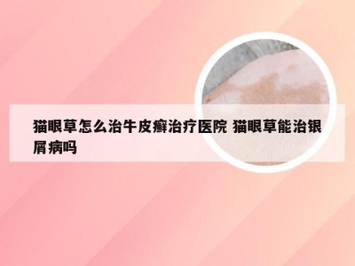 猫眼草怎么治牛皮癣治疗医院 猫眼草能治银屑病吗