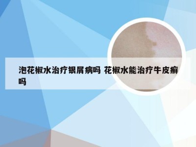 泡花椒水治疗银屑病吗 花椒水能治疗牛皮癣吗