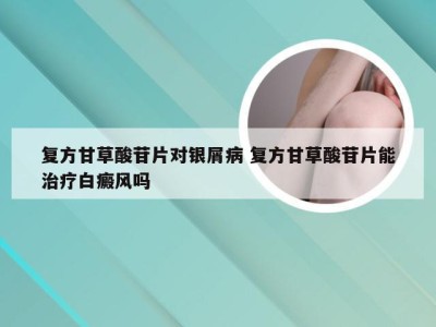 复方甘草酸苷片对银屑病 复方甘草酸苷片能治疗白癜风吗