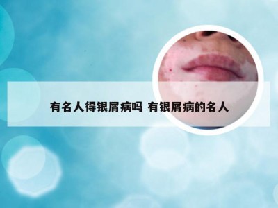 有名人得银屑病吗 有银屑病的名人
