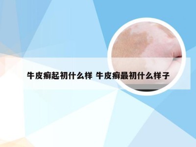 牛皮癣起初什么样 牛皮癣最初什么样子