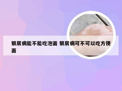 银屑病能不能吃泡面 银屑病可不可以吃方便面