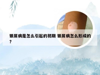 银屑病是怎么引起的初期 银屑病怎么形成的?