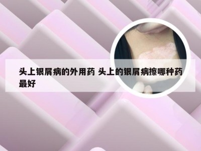 头上银屑病的外用药 头上的银屑病擦哪种药最好