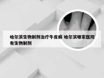 哈尔滨生物制剂治疗牛皮癣 哈尔滨哪家医院有生物制剂