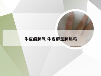 牛皮癣肺气 牛皮癣是肺热吗