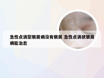 急性点滴型银屑病没有银屑 急性点滴状银屑病能治愈