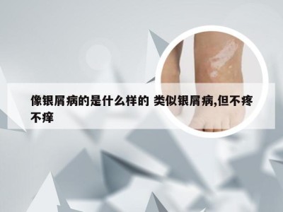 像银屑病的是什么样的 类似银屑病,但不疼不痒