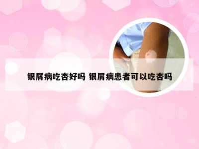 银屑病吃杏好吗 银屑病患者可以吃杏吗