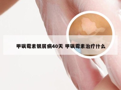 甲砜霉素银屑病40天 甲砜霉素治疗什么