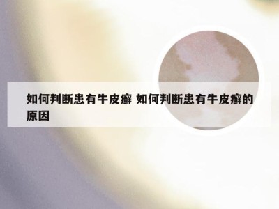如何判断患有牛皮癣 如何判断患有牛皮癣的原因