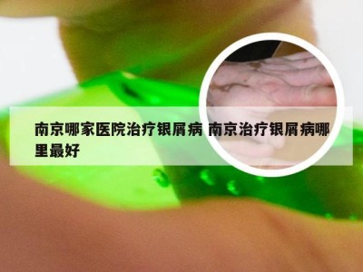 南京哪家医院治疗银屑病 南京治疗银屑病哪里最好