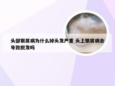 头部银屑病为什么掉头发严重 头上银屑病会导致脱发吗
