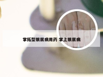 掌拓型银屑病用药 掌上银屑病