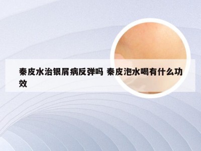 秦皮水治银屑病反弹吗 秦皮泡水喝有什么功效