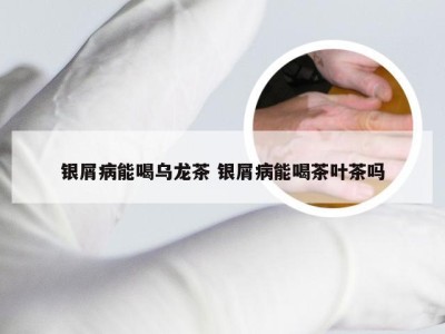 银屑病能喝乌龙茶 银屑病能喝茶叶茶吗