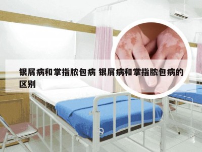 银屑病和掌指脓包病 银屑病和掌指脓包病的区别
