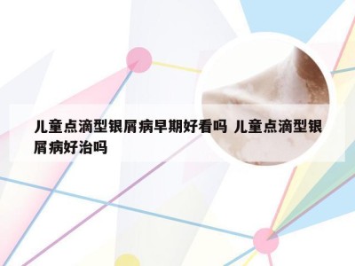 儿童点滴型银屑病早期好看吗 儿童点滴型银屑病好治吗