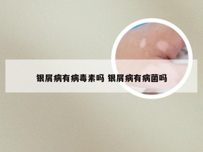 银屑病有病毒素吗 银屑病有病菌吗