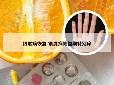 银屑病恢复 银屑病恢复期特别痒