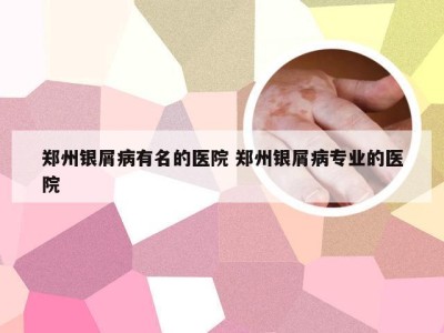 郑州银屑病有名的医院 郑州银屑病专业的医院