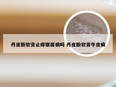 丹皮酚软膏止痒银屑病吗 丹皮酚软膏牛皮癣