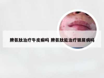 脾氨肽治疗牛皮癣吗 脾氨肽能治疗银屑病吗