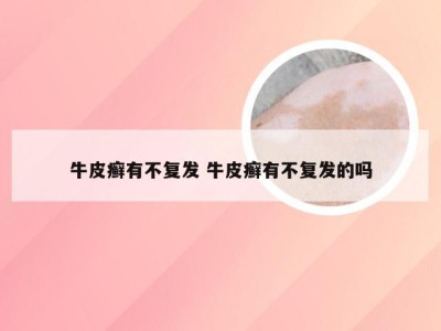 牛皮癣有不复发 牛皮癣有不复发的吗