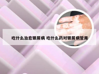 吃什么治愈银屑病 吃什么药对银屑病管用