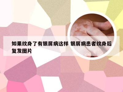 如果纹身了有银屑病这样 银屑病患者纹身后复发图片
