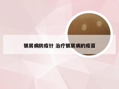 银屑病防疫针 治疗银屑病的疫苗