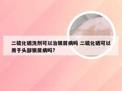 二硫化硒洗剂可以治银屑病吗 二硫化硒可以用于头部银屑病吗?