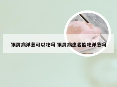 银屑病洋葱可以吃吗 银屑病患者能吃洋葱吗
