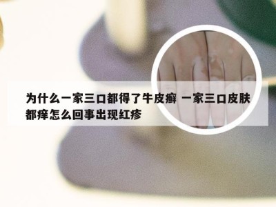 为什么一家三口都得了牛皮癣 一家三口皮肤都痒怎么回事出现红疹