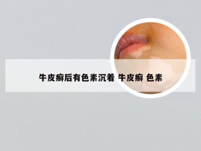 牛皮癣后有色素沉着 牛皮癣 色素