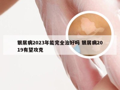 银屑病2023年能完全治好吗 银屑病2019有望攻克