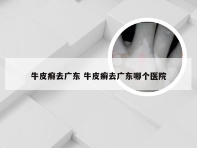 牛皮癣去广东 牛皮癣去广东哪个医院