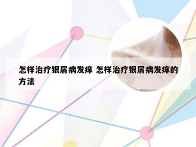 怎样治疗银屑病发痒 怎样治疗银屑病发痒的方法